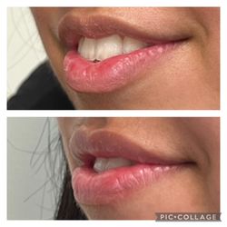 Amanda Maloney MD, FRCS C, DABO - A lovely balancing - the upper lip was treated to bring more proportion.