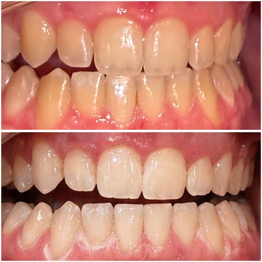 Deebeaut - Teeth Whitening Near Me Deebeaut - Teeth Whitening Near Me
