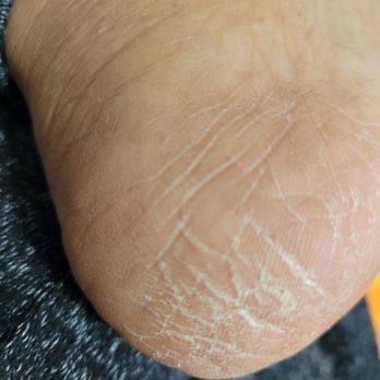 Venice Nail Studio - Poor pedicure. - Nail Salons Near Me - Citrus Heights, California Venice Nail Studio - Poor pedicure. - Nail Salons Near Me - Citrus Heights, California