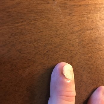 Nail Cops - Pics of damaged nails. - Nail Salons Near Me - Minneapolis, Minnesota