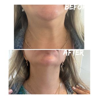 Diamond Med Spa - Neck bands treated with botox - Medical Spas Near Me - Miami Beach, Florida Diamond Med Spa - Neck bands treated with botox - Medical Spas Near Me - Miami Beach, Florida