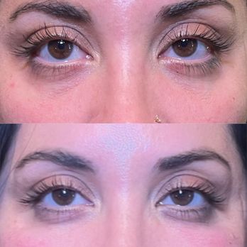 J W Aesthetic - Before and after Ez gel under eyes . - Aestheticians Near Me