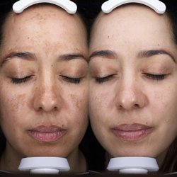 OrangeTwist - Amazing skin transformation by our esthetician Tiffany