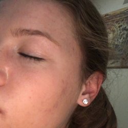 True Simplicity Acne & Skin Care - Long distance client after