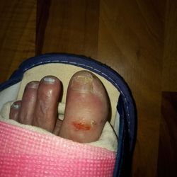 Podiatry Associates of Indiana Foot and Ankle Institute - Foot cut by cast