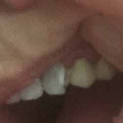 Mountain Dental Associates - Obvious dark remains in incisor, also broken from drilling to thinly