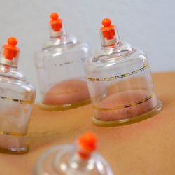 Lifekind Health - Victorville - Close up shot of cupping.
