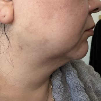 Revive Med Spa - Burns on right side - Medical Spas Near Me - Roseville, California Revive Med Spa - Burns on right side - Medical Spas Near Me - Roseville, California