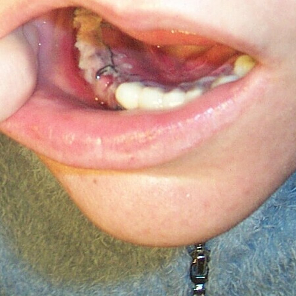 Theresa Keefe, DMD - White fish-flesh material (bone lymphoma) coming out of jawbone after very toxic nickel-beryllium bridge was removed. - Periodontists Near Me - Canton, Connecticut