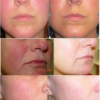 Laser Body Solutions - Genesis Treatment for Rosacea - Laser Hair Removal Near Me - Hamden, Connecticut Laser Body Solutions - Genesis Treatment for Rosacea - Laser Hair Removal Near Me - Hamden, Connecticut