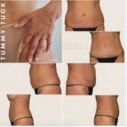 Rivela Plastic Surgery - Tummy tuck at Rivela Plastic Surgery