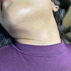 La Moda Electrolysis - After electrolysis hair removal