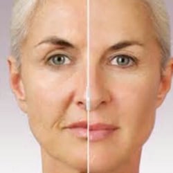 Elite Med Spa - The magic of juvederm