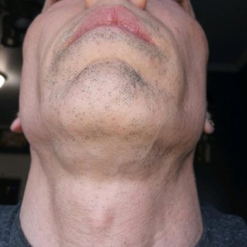 LightRx - Canton - Patches of hair that their lasers couldn't make fall out all around my goatee and mouth areas. - Medical Spas Near Me - Canton, Michigan LightRx - Canton - Patches of hair that their lasers couldn't make fall out all around my goatee and mouth areas. - Medical Spas Near Me - Canton, Michigan