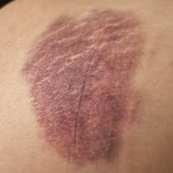 Kona Thai Massage - Bruise on her hip the size of a large grapefruit