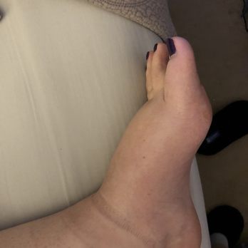 Jordan Young Institute - Extreme swelling & pain after wearing ankle boot all day. - Sports Medicine Near Me - Virginia Beach, Virginia Jordan Young Institute - Extreme swelling & pain after wearing ankle boot all day. - Sports Medicine Near Me - Virginia Beach, Virginia