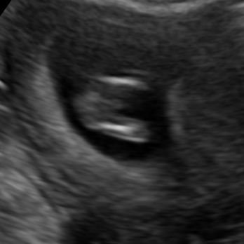 Cloud 9 Mobile Ultrasound - we got several shots of boy junk - Ultrasound Imaging Centers Near Me Cloud 9 Mobile Ultrasound - we got several shots of boy junk - Ultrasound Imaging Centers Near Me