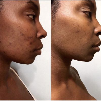 Advances Treatments - We specializes in treating acne, acne scarring and hyperpigmentation. Each facial is customized to each client. Call for your appointment today . Advances Treatments - We specializes in treating acne, acne scarring and hyperpigmentation. Each facial is customized to each client. Call for your appointment today .