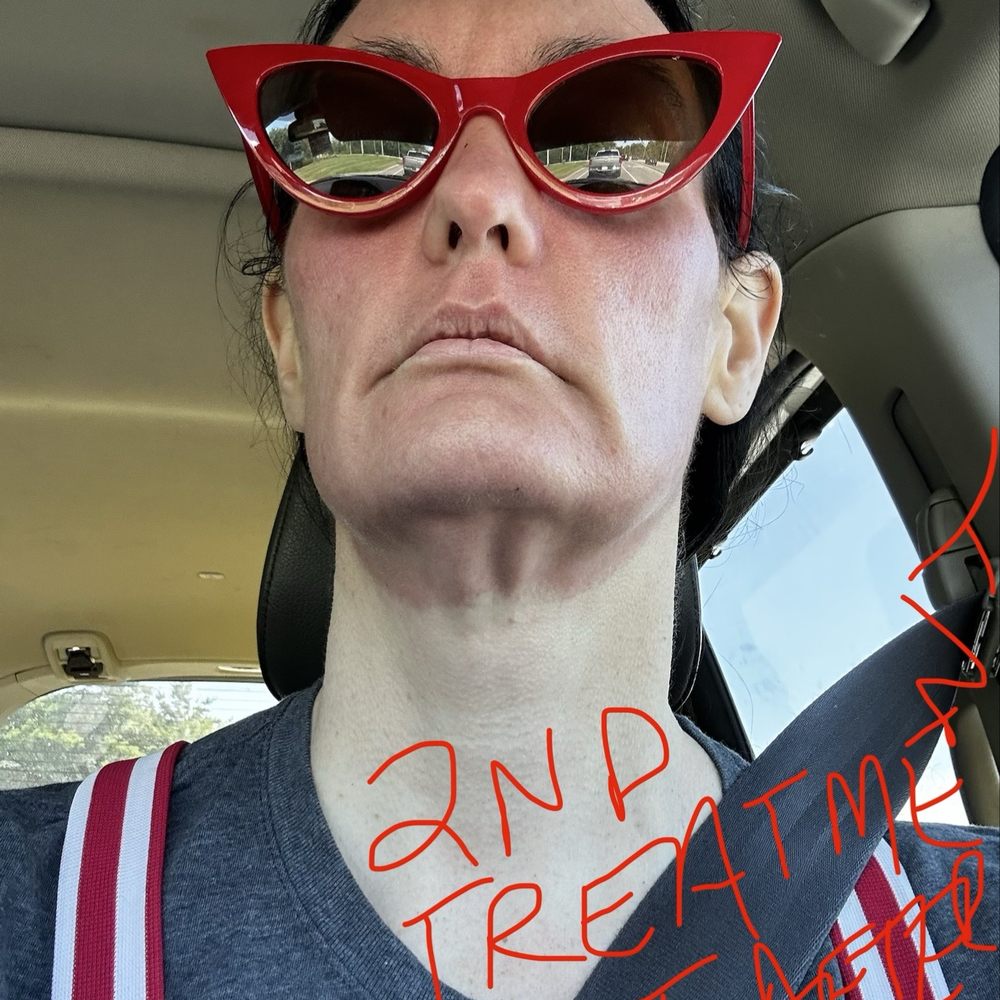 Turkle & Associates - Second Treatment (both Moxy & BBL lasers) same day right after in the car - Cosmetic Surgeons Near Me - Carmel, Indiana