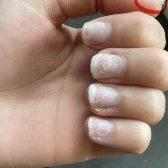 Glamour Nail Salon - You can see the acrylic still attached to her thumb nail here. - Nail Salons Near Me - Berkeley, California