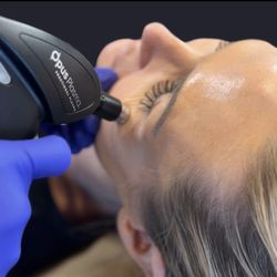 RF Microneedling