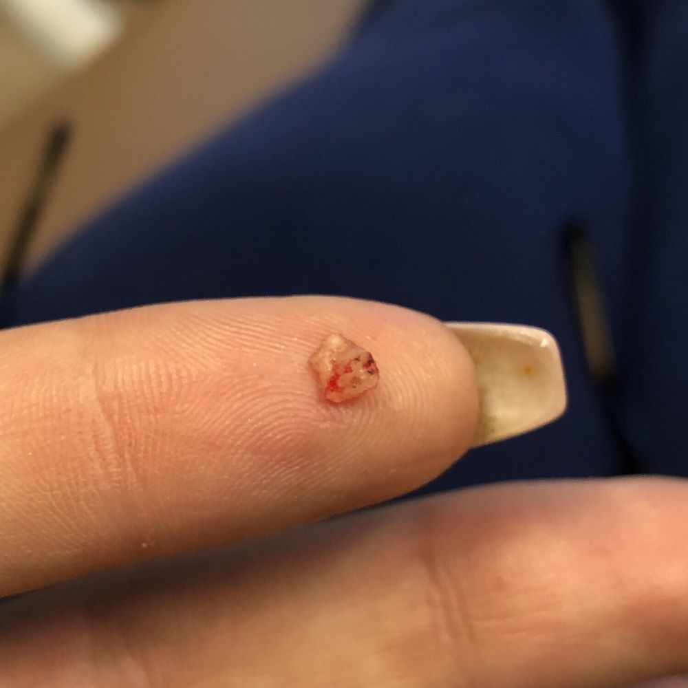 Covington Dental Care - One of two pieces of root that was removed from my mouth in the second surgery. - General Dentistry Near Me - Covington, Louisiana