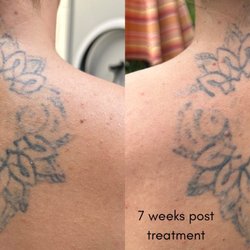Atlantic Laser Tattoo Removal