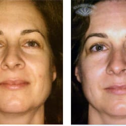 MY Facials & Microdermabrasion - After 10 Microcurrent Treatments