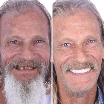 Britely Dentures + Implants Studio - Final result of full mouth dental implants! - Oral Surgeons Near Me - Surprise, Arizona