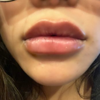MedSpa California - A little swollen but beautiful! - Laser Hair Removal Near Me - San Ramon, California MedSpa California - A little swollen but beautiful! - Laser Hair Removal Near Me - San Ramon, California