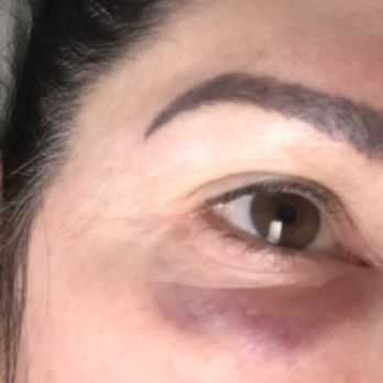 YouthFill MD - Day 1 Swelling and Black Eye Developing - Medical Spas Near Me - Los Angeles, California YouthFill MD - Day 1 Swelling and Black Eye Developing - Medical Spas Near Me - Los Angeles, California