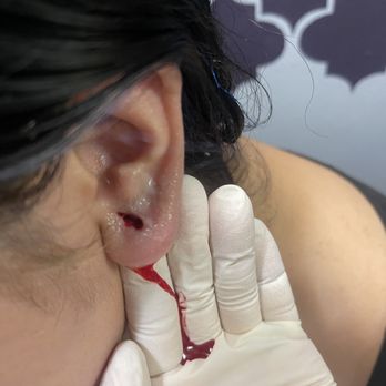 L & G Tattoos - The tear that was caused due to the malpractice of L&G Tattoos and Piercings - Tattoo Near Me - Los Angeles, California