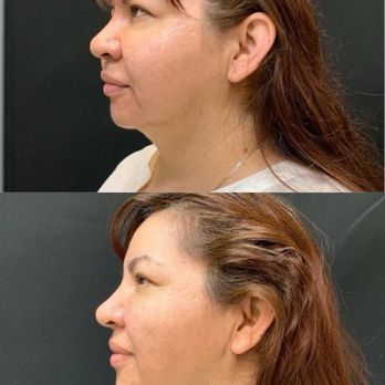 MD Cosmetic Clinic - Face and Neck Thread lift . - Medical Spas Near Me - Lake Forest, California MD Cosmetic Clinic - Face and Neck Thread lift . - Medical Spas Near Me - Lake Forest, California