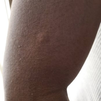 Romer Times Square - bite on my arm. - Hotels Near Me - New York, New York Romer Times Square - bite on my arm. - Hotels Near Me - New York, New York