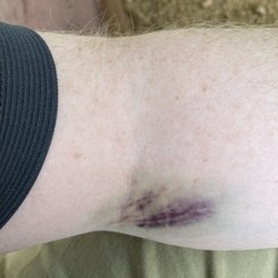 Quest Diagnostics - Track marks? Nope.  This is from getting my blood sample taken from Quest Diagnostics inside Tom Thumb on Arapaho.