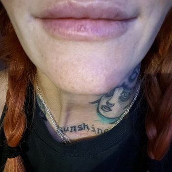 Injection Goddess - 8 hours after procedure. - Medical Spas Near Me Injection Goddess - 8 hours after procedure. - Medical Spas Near Me