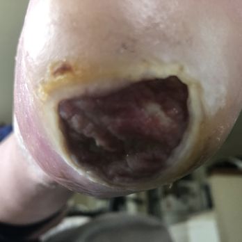 Columbus Podiatry & Surgery - Hack job, I still believe my heel was not any better - Podiatrists Near Me - Columbus, Ohio
