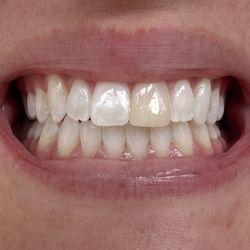 Newport Beach Dental - Dr. Lance Alder & Dr. Jacob Barton - Before fixing front tooth