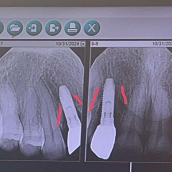 Illinois Valley Oral Surgeons - The bone loss highlighted from the misplacement of one implant. - Oral Surgeons Near Me - Ottawa, Illinois Illinois Valley Oral Surgeons - The bone loss highlighted from the misplacement of one implant. - Oral Surgeons Near Me - Ottawa, Illinois