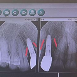 Illinois Valley Oral Surgeons - The bone loss highlighted from the misplacement of one implant.