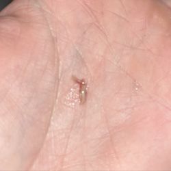 All Star Kids Family Dental - Bone spur from extraction