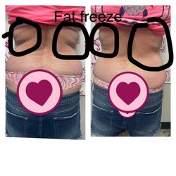 Fat freeze 30min Nonsurgical procedure. First treatment.