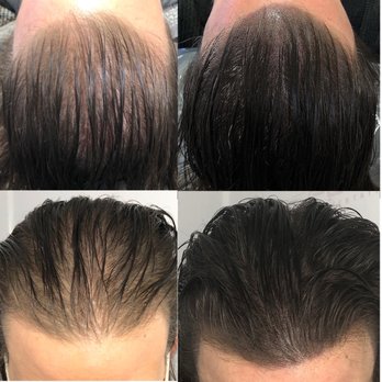 Full Micropigmentation - Hair Loss Centers Near Me - Las Vegas, Nevada Full Micropigmentation - Hair Loss Centers Near Me - Las Vegas, Nevada