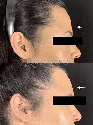 Forehead/Temple Filler - Fillers injected in the forehead to help add volume and address concavity. Forehead/Temple Filler - Fillers injected in the forehead to help add volume and address concavity.