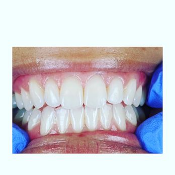 Kaizen Dental Center - Downtown Honolulu - The final result! My teeth back to being straight. - General Dentistry Near Me - Honolulu, Hawaii