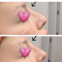 Absolute Integrated Med Spa - Plainfield - Rhonda Policandriotes RN BSN CANS Instagram @injectionsby_rhonda Facebook Rhonda Policandriotes #lipfillers #lipinjections #botox