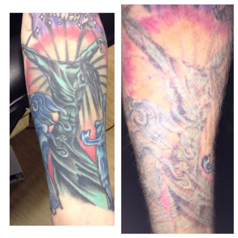 Disappearing inc. - Tattoo Removal Near Me - Framingham, Massachusetts