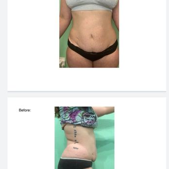 Vanity Beauty Boutique - Before and after 6 sessions - Teeth Whitening Near Me - Las Vegas, Nevada Vanity Beauty Boutique - Before and after 6 sessions - Teeth Whitening Near Me - Las Vegas, Nevada