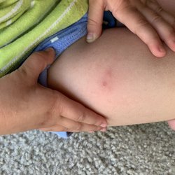 Olympia Pediatrics - Infected injection site