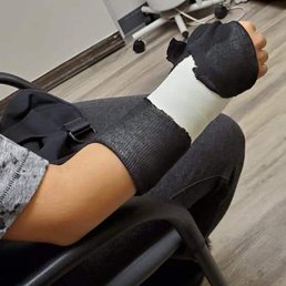 2 days after my visit at ER. Cast was placed. 2 days after my visit at ER. Cast was placed.